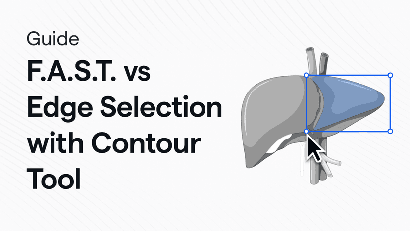 Liver Tumor segmentation: F.A.S.T. vs Edge Selection with Contour tool