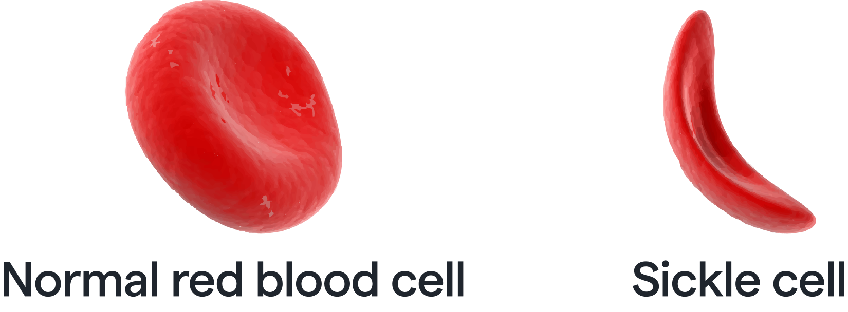 6512a16e1da5ba396702f0f4_RBC vs Sickle Cell.png